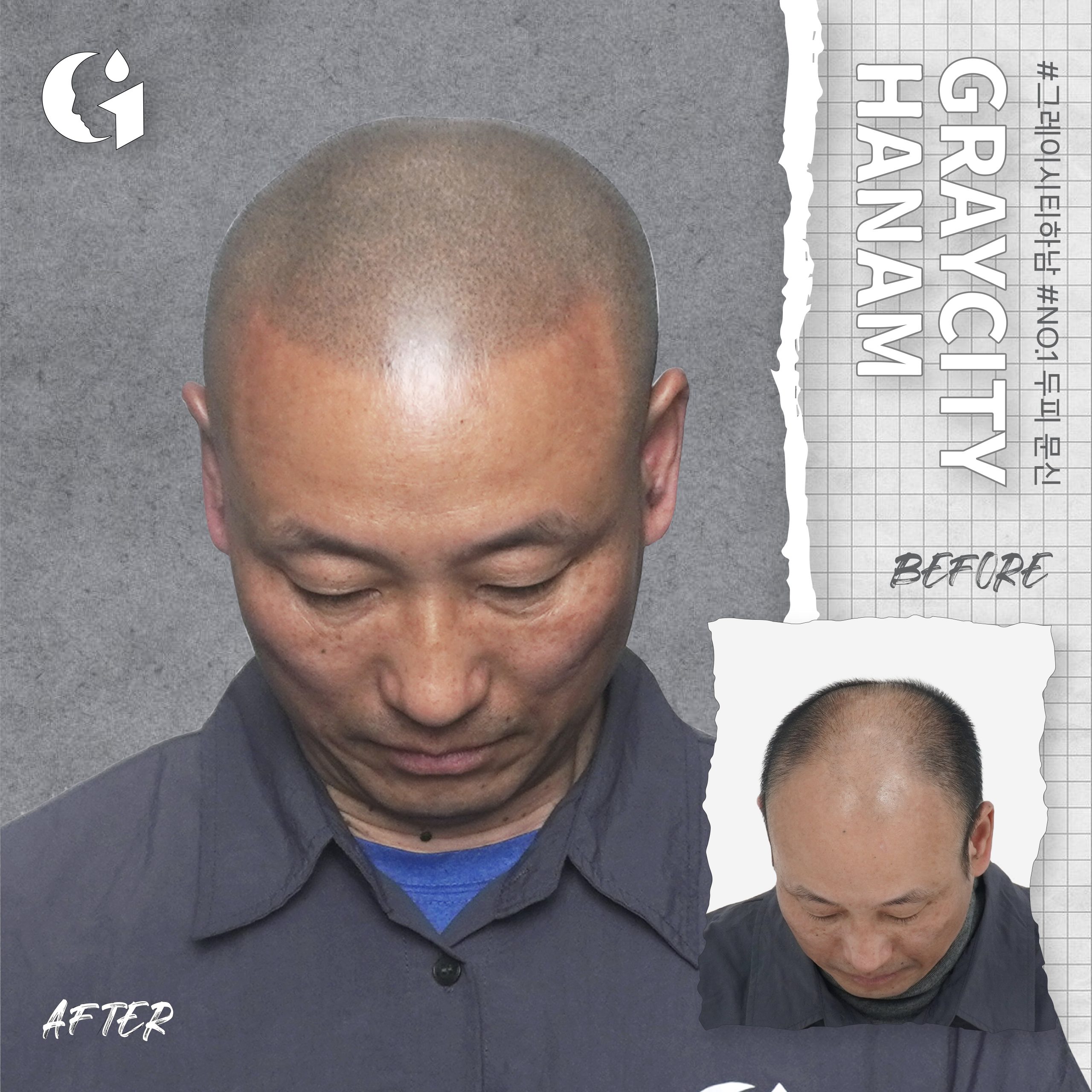 The Truth About Scalp Tattoos